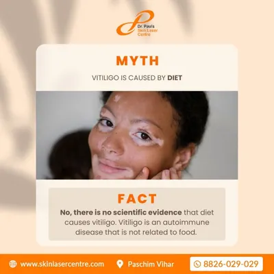 A common myth is that certain foods cause vitiligo. The fact is, vitiligo is an autoimmune condition and is not related to your diet. Understanding the science behind the condition is the first step toward effective management.