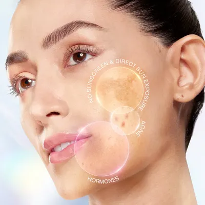 A technical beauty photograph for a Lakmé skincare product. This image uses graphic overlays to pinpoint common skin concerns like sun exposure, acne, and hormonal effects, clearly communicating the problem the product aims to solve.