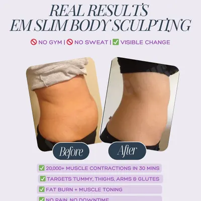 This before-and-after photo shows the real results of EM Slim. After a series of sessions, this client saw a visible reduction in abdominal fat and improved muscle definition. This is what targeted fat burn and muscle toning looks like.