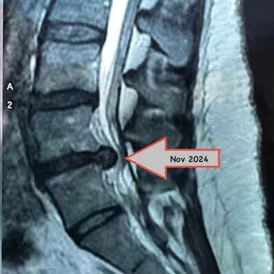 This is the initial MRI of a patient from Sydney who came to me with a debilitating disc bulge. After being advised for surgery by multiple specialists, she put her trust in our physiotherapy process.