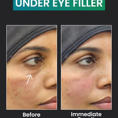 This before-and-after image shows the immediate effect of under-eye fillers in correcting the tear trough area. The treatment smooths the transition between the lower eyelid and cheek, reducing the shadow that makes eyes look tired.