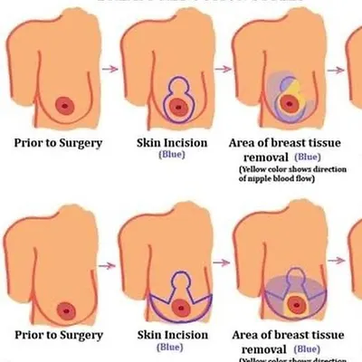 There are different surgical approaches to breast reduction, and we choose the one best suited for you. This illustration shows two common styles, detailing the incision patterns and the areas where excess breast tissue is removed to achieve the desired size and shape.