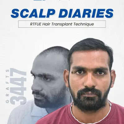 Mr. Durgesh’s transformation isn’t just about graft numbers. It’s about precision, planning, and doing things the right way. With the RT-FUE Sapphire technique and 3,447 grafts, every step was intentional, every detail carefully executed by experienced hands.