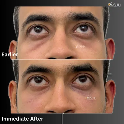 An immediate before and after of an under-eye filler treatment. Just 1 ml of hyaluronic acid was used to fill the hollows, significantly reducing the tired and dull look.