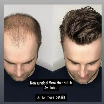 A clear before and after view of our non-surgical men's hair patch. This system is designed to cover male pattern baldness, integrating seamlessly with existing hair for a completely natural and undetectable finish.