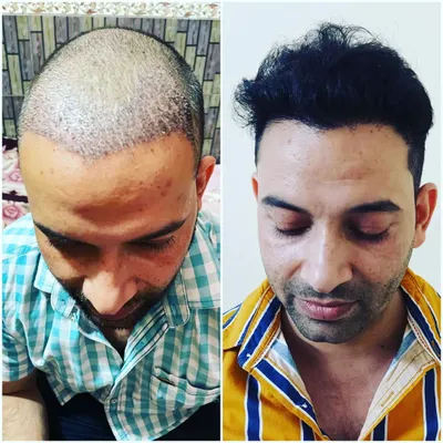 A clear comparison showing a patient's scalp before the procedure and after, with a full and dense hair transplant result. This is the kind of life-changing result we strive for.