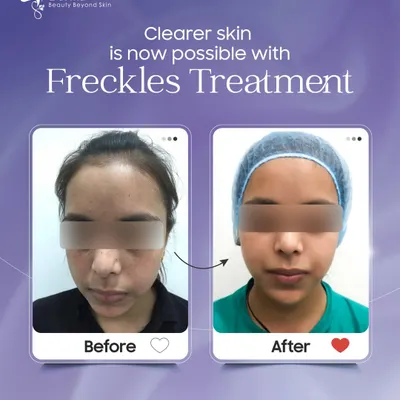 This before-and-after shows the significant reduction of freckles using our advanced treatments. We use safe and effective methods like laser therapy to target pigmentation, resulting in clearer, more even-toned skin and renewed confidence for our patient.