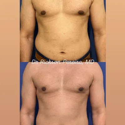 This is the result of my evidence-based fat loss program after just 8 weeks. We focus on true body recomposition, reducing fat primarily in the mid-section while carefully preserving vital muscle mass. This approach ensures you not only look better but also improve your long-term metabolic health.