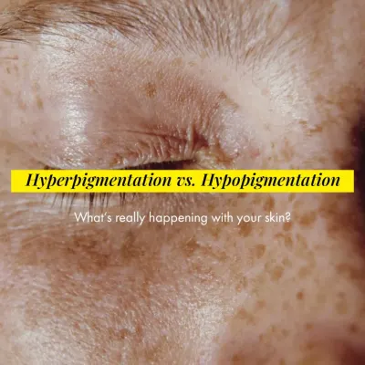 Understanding the difference between hyperpigmentation (dark spots) and hypopigmentation (light spots) is the first step. This image highlights the visual characteristics of these common concerns.
