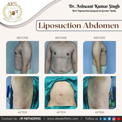 This before and after result of abdominal liposuction shows a significant reduction in fat and a much-improved body contour. My technique focuses on creating a natural, sculpted appearance.