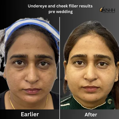 A tired appearance is often caused by volume loss under the eyes and in the cheeks. For this pre-wedding transformation, I used hyaluronic acid fillers to restore that youthful contour, complemented by chemical peels for an overall brighter complexion.