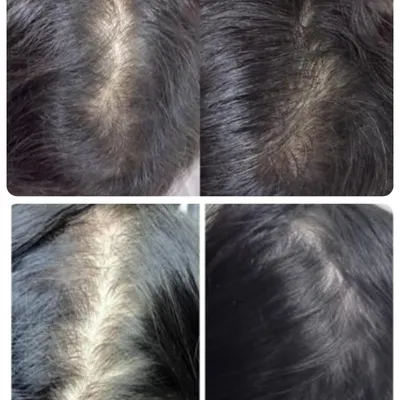 This before-and-after image shows the visible improvement in hair density and scalp coverage following a combination therapy for hair restoration. It demonstrates that with the right diagnosis and consistent treatment, significant regrowth is possible.