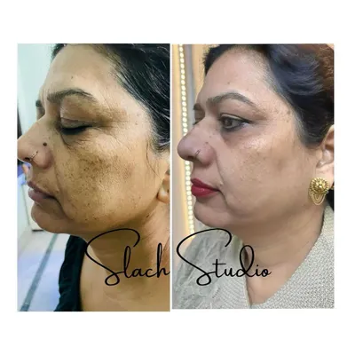 A powerful transformation showing a significant reduction in deep-set pigmentation and wrinkles after the Korean Glass Skin treatment. The skin appears smoother, firmer, and several shades lighter.
