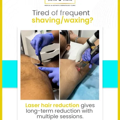 This visual directly addresses the hassle of traditional hair removal methods. Our laser treatments provide a long-term reduction, freeing you from the constant upkeep of shaving and waxing.