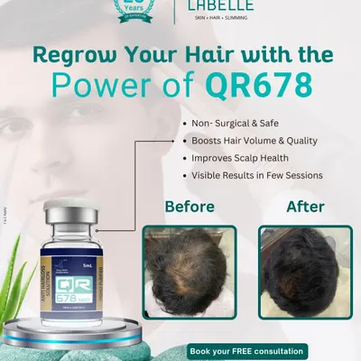 A powerful before and after of our QR678 treatment. This non-surgical approach effectively tackles hair loss, resulting in visibly thicker hair and improved scalp health in just a few sessions.