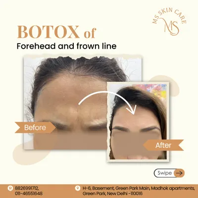 This before and after shows the significant yet natural-looking reduction of forehead and frown lines using Botox. The treatment relaxes the underlying muscles, resulting in smoother, more youthful skin.