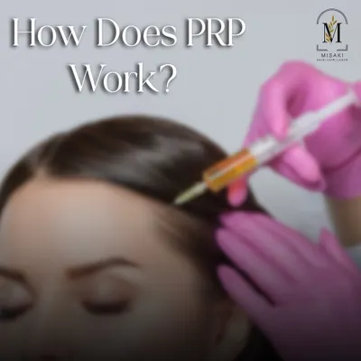 How does PRP work? This image shows the core of the treatment: injecting platelet-rich plasma directly into the scalp to target hair follicles where they need it most.