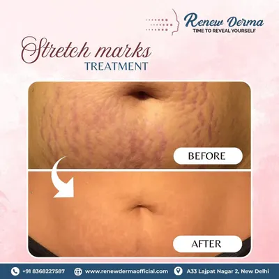 Many products promise to fix stretch marks but fail. This client saw incredible results after just three sessions of our professional stretch mark treatment.
