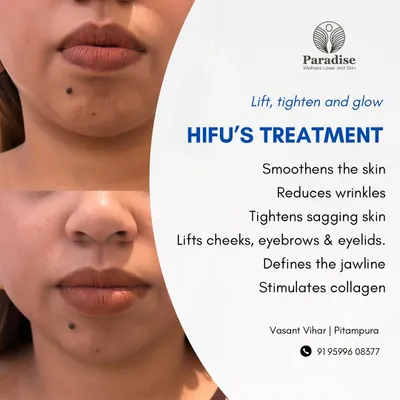 This before-and-after demonstrates how HIFU treatment visibly tightens sagging skin around the mouth and jawline. By stimulating collagen, it smooths the skin and restores a more youthful contour.