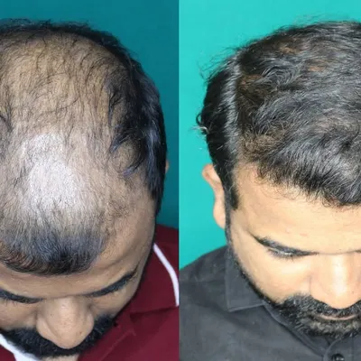 This is a classic case of advanced crown balding. The 'after' photo shows how we achieved complete coverage using a high number of grafts, resulting in a full and dense appearance.