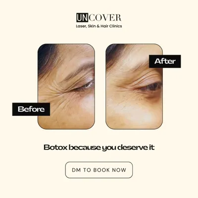 Here is a before and after of a Botox treatment for crow's feet. Notice how the lines around the eyes are softened, giving a more rested and youthful appearance while maintaining natural expression.