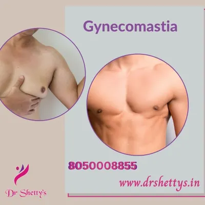 This before and after image shows the results of a gynecomastia treatment. The procedure effectively reduces excess breast tissue, resulting in a flatter, more sculpted, and masculine chest profile.