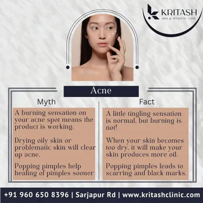 Let's clear up some common myths about acne. A burning sensation is a sign of irritation, not effectiveness, and popping pimples will almost always lead to scarring or post-inflammatory hyperpigmentation. Proper treatment focuses on balance, not aggression.