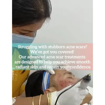 A client undergoes an advanced treatment for stubborn acne scars. We use targeted procedures like microneedling to stimulate the skin's natural healing process, helping to build collagen and visibly reduce the depth and texture of scars for smoother, more radiant skin.