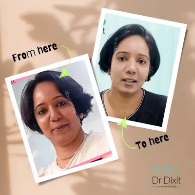 This is a powerful example of what a customized anti-aging plan can achieve. By addressing specific concerns with the right procedures, we were able to create a naturally refreshed and rejuvenated appearance for my patient.