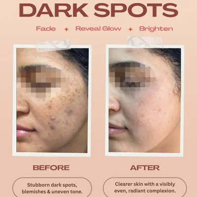 A clear transformation showing the fading of stubborn dark spots and blemishes. Our targeted treatments result in a visibly clearer, more even, and radiant complexion, restoring skin confidence.