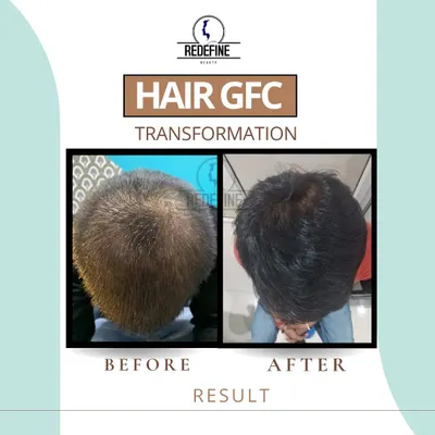 A clear before and after result of our Hair GFC Transformation. This image shows a significant increase in hair volume and coverage on the crown area, demonstrating the power of this non-surgical hair restoration treatment.