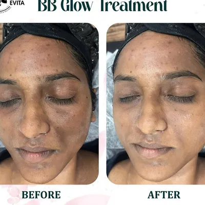 See the immediate transformation with our BB Glow treatment. This client wanted to address uneven skin tone and blemishes. The 'after' photo shows how the semi-permanent serum provides light coverage, reduces redness, and creates a flawless, dewy finish.