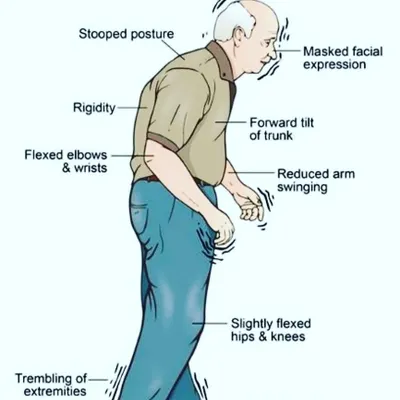 This diagram illustrates the physical symptoms of Parkinson's disease. My therapeutic approach uses targeted asanas and breathwork to help patients regain a sense of control, improve balance, and reduce the muscular rigidity associated with the condition.