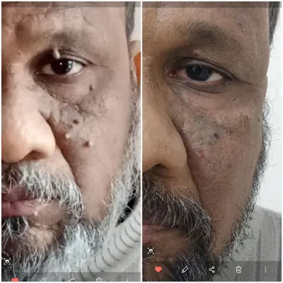 A powerful example of facial rejuvenation after the removal of multiple skin tags. The 'before' on the left shows numerous growths, while the 'after' on the right displays the clear, smooth skin post-treatment.