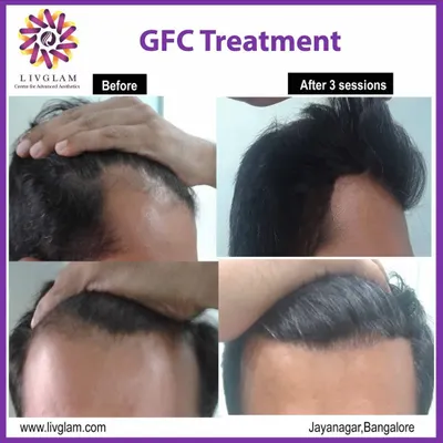 This client's hairline was restored after just three sessions of our non-surgical GFC treatment. Notice the significant increase in hair density and the natural-looking frontal coverage.