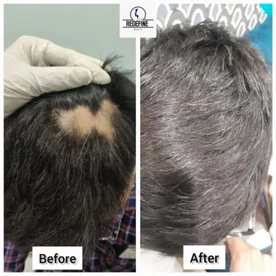 A fantastic before and after result for a client with alopecia areata. The initial image shows a significant bald patch, and the after image displays complete hair regrowth, showcasing the effectiveness of our targeted treatment plan.