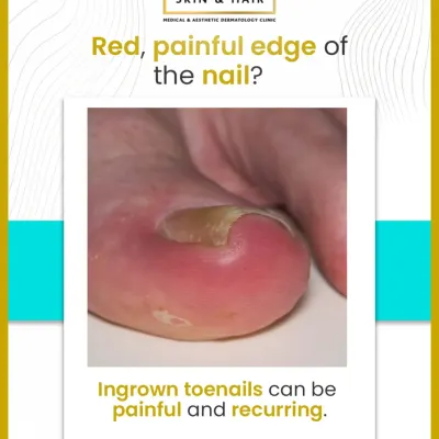 A red, painful, and swollen nail edge is a classic sign of an ingrown toenail. This condition can be recurring and lead to infection if not properly managed by a dermatologist.