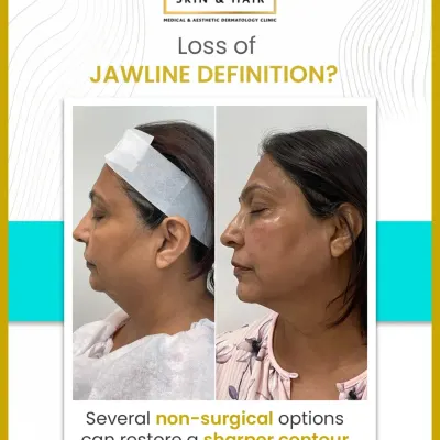 This transformation showcases the power of a well-defined jawline. By strategically combining non-surgical treatments, I was able to restore structure and lift to the lower face, resulting in a significantly sharper and more youthful profile for my patient.