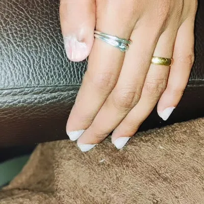 This is the "before" shot of a client's damaged natural nail. It's important to handle situations like this with care to prevent further damage and promote healthy growth.