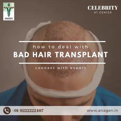 Dealing with a bad hair transplant can be emotionally draining. If you are unhappy with a previous procedure from another clinic, connect with our experts. We specialize in corrective surgery to fix unnatural hairlines and poor results.