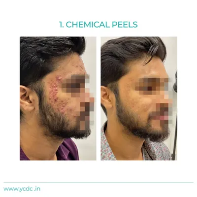 This patient's journey shows a significant reduction in active acne and inflammation after a series of customized chemical peels. The treatment helped clear his skin and improve overall texture.