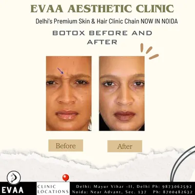 A real client before-and-after of a Botox treatment. The image clearly shows the smoothing of deep frown lines between the eyebrows, resulting in a more relaxed and less tired appearance.