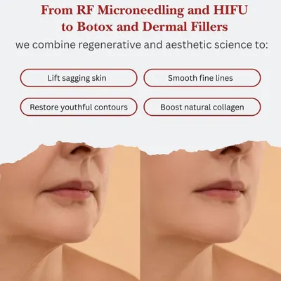 This before and after visual demonstrates how we address sagging skin around the jawline and mouth. We use a combination of treatments like RF Microneedling, HIFU, and fillers to lift, smooth fine lines, and restore youthful contours.