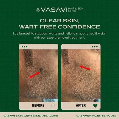 This demonstrates the precise removal of a facial wart from a patient's beard area. Treating facial growths requires careful technique to ensure complete removal and prevent scarring, which is my primary goal for all my patients.