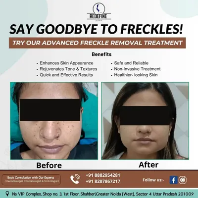 A fantastic before-and-after result for freckle removal. This treatment helps to even out skin tone and texture, giving the face a clearer and more rejuvenated appearance.