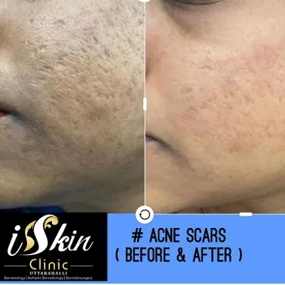 This before and after comparison shows a significant reduction in atrophic acne scars and improved skin texture for one of our patients. Our targeted treatments for post-acne scarring are designed to smooth the skin's surface and restore confidence.