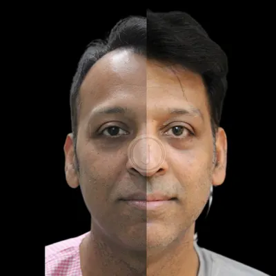 This patient received a combination of skin and hair restoration treatments. The 'before' shows sun damage and a receding hairline, while the 'after' reveals hydrated skin and visibly improved hair density. This transformation was achieved over two months with a dedicated plan.