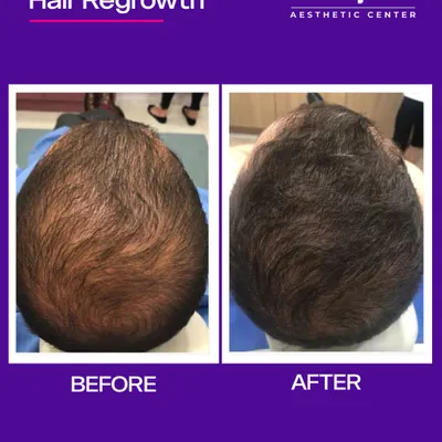 The results speak for themselves. This before and after photo shows the significant improvement in hair density and coverage after our customized hair regrowth treatment plan.