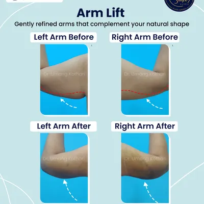 Sagging skin on the upper arms, often called "bat wings," is a common concern. An arm lift, or brachioplasty, is a procedure I perform to remove this loose skin and fat. The result is a smoother, more toned arm contour that complements your natural body shape, as you can see in this before and after.