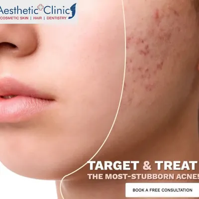 Stubborn acne requires a targeted clinical approach. I offer customized laser treatments designed to address persistent breakouts and help you achieve clearer skin.